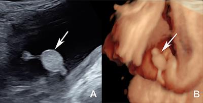 Congenital perineal hamartomas with rectal duplication: A case report